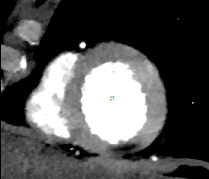 A gated cardiac CTA scan was performed on the IQon Spectral CT that showed normal coronary arteries, but a suspicious area that