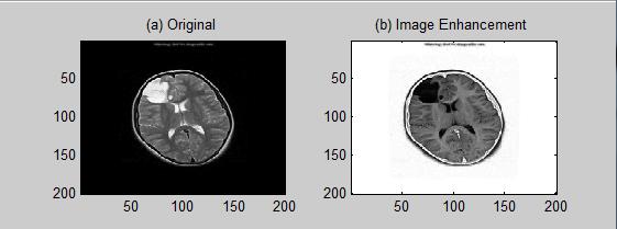 The image enhancement in Figure 2 represents clear contour of glioma tumour. The values of control parameters in Equation (2) are α and β. The chosen parameter values are based on the value in Tumour.