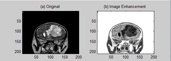and Fig. 0. Image Enhancement of Tumour 9 Figure 0 shows the image enhancement by using sigmoid filter which the value of control parameters are α = 50 and β = 240. Fig. 7.