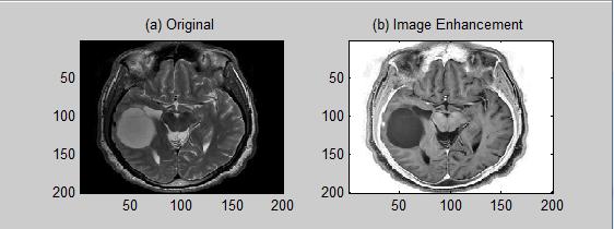 Image Enhancement of Tumour 7 Figure 8 shows the image enhancement by using sigmoid filter which the value of control parameters are α = 0 and Fig.
