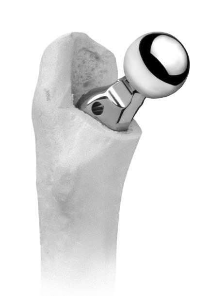 APS Natural-Hip System Surgical Technique Attachment of the Femoral Head Once the implant is fully seated in the femoral canal, place the selected Femoral Head Provisional onto the taper of the