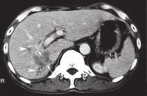 The gross specimen showed a 1 x 2 cm ulcerative lesion around the ampulla of Vater extending into the common bile duct and causing obstruction of the bile duct.