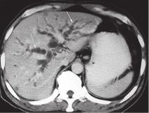 Singapore Med J 2002 Vol 43(11) : 595 9a 9b 9c Fig. 9 Pancreatic head carcinoma.