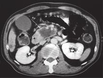 Choledocholithiasis The classical US appearance of a common bile duct stone is a hyperechoic structure with acoustic shadow within the bile duct (Fig. 7).