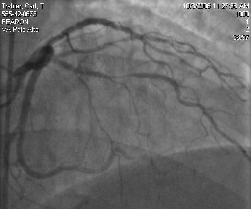 FFR should not guide ALL PCI!