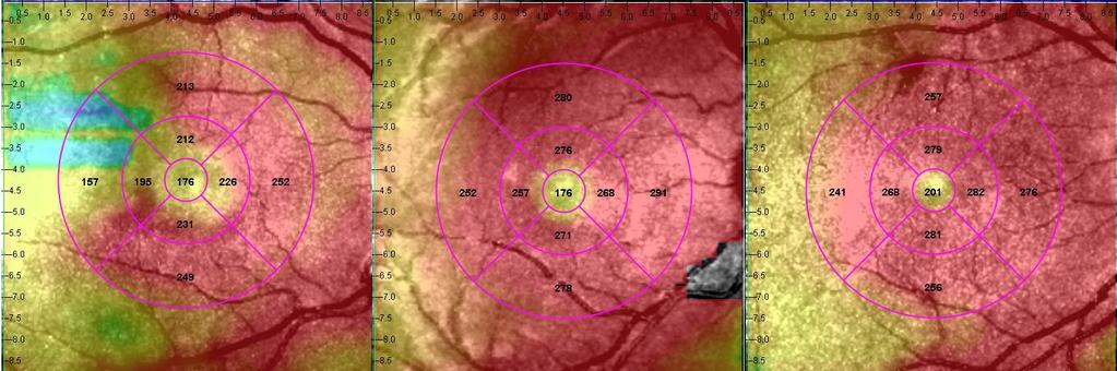 10 Figure Captions Figure 1. Representative macular SD-OCT maps showing mean thicknesses of 9 ETDRS-like subfields within the polar 3 microperimetry testing grid.