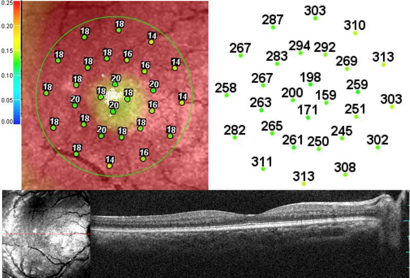 BCVA 20/20). (Top Left) Microperimetry Polar 3 test grid superimposed on the SLO infrared image.