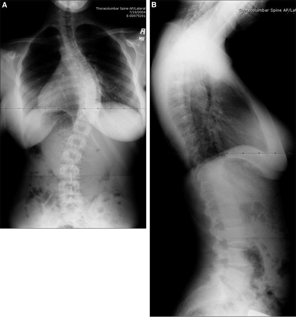 Figure 1. A. Preoperative posterior-anterior radiograph. B. Note the thoracic hypokyphosis on the lateral radiograph.