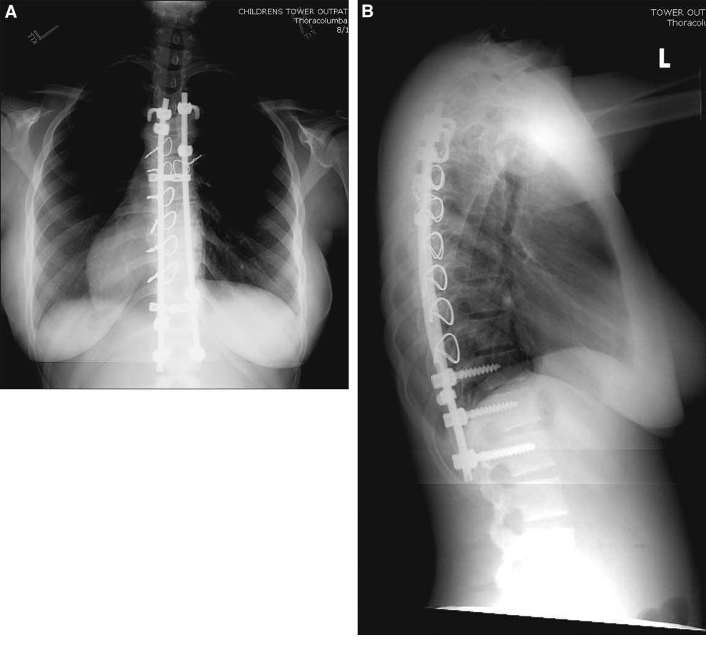 Figure 2. A. Postoperative posterior-anterior radiograph. B. Postoperative lateral radiograph. suggesting some heritable factors.