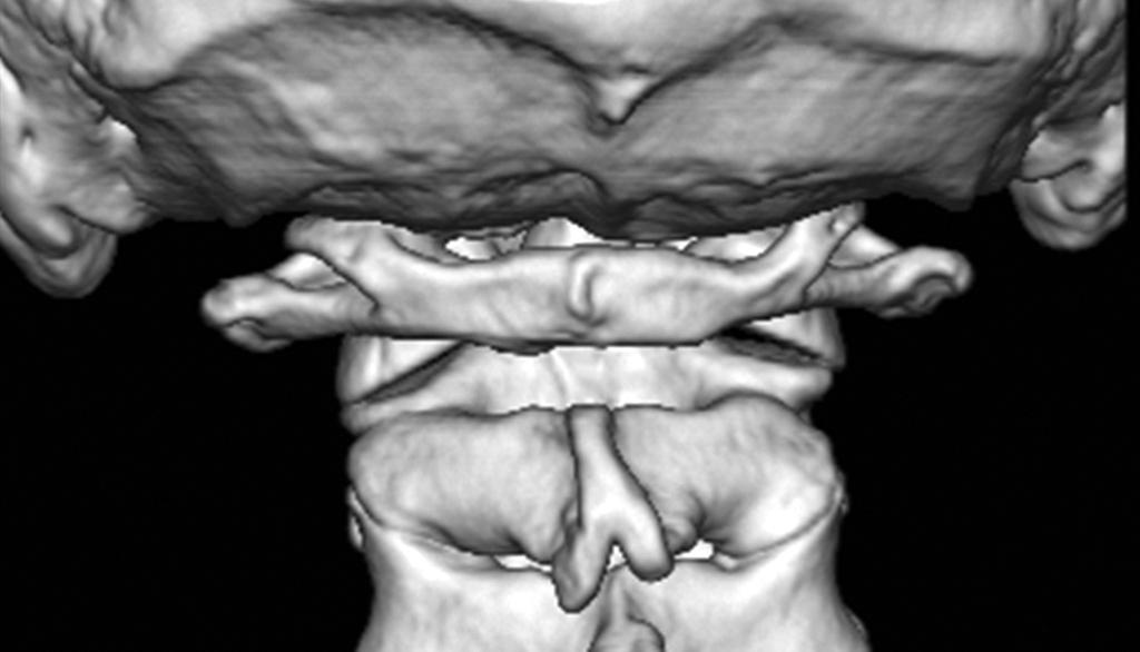 Preliminary Analysis of 200 3-Dimensional Cervical CT Scans A B C D 47 Fig 1. Various morphologic types of ponticuli posticus seen on posterior view of 3-D CT images.