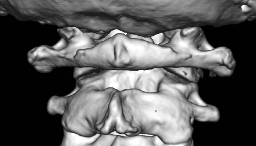 5%) were excluded because poor visualization of the posterior arch of the atlas due to overlapping of the mastoid process or the occiput.