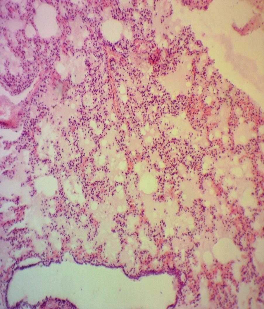 Organ: Lung (100X, medium power) 1) The blood capillaries within the alveolar septa are engorged with blood 2) Pinkish