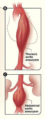Aneurysm and coarctation of the aorta Aortic aneurysm: The arch of the aorta lies behind the manubrium sterni.