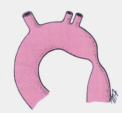 Aneurysm and coarctation of the aorta Coarctation of the aorta: A congenital narrowing of the aorta just proximal, opposite, or distal to the site of attachment of the ligmentum arteriosum.