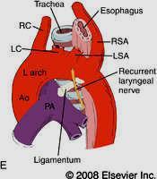concave surface of the aortic arch It is the remains of the