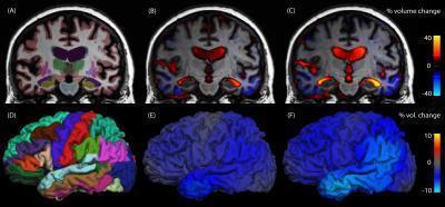 Brain Imaging Serial MRI brain scans, taken six months apart, show progression from mild cognitive impairment to Alzheimer's