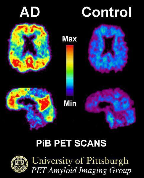 Brain Imaging Klunk, W.E., et al.