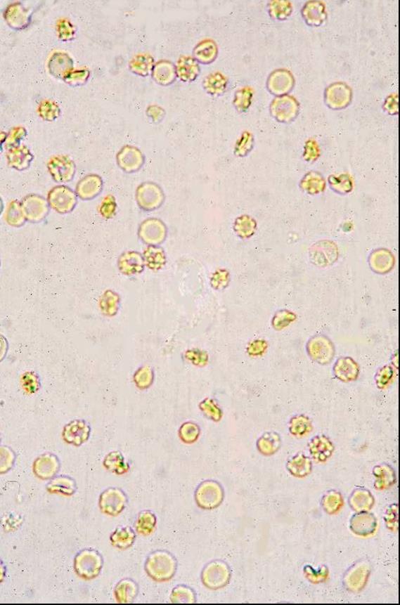 5 2 times diameter of RBC Usually neutrophils Consider collection method when interpreting High-power field (40x objective) Erythrocytes (RBCs) Leukocytes (WBCs)