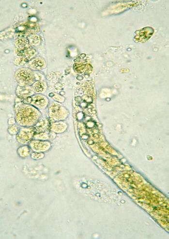 normal Increased numbers suggest glomerular proteinuria Epithelial casts, coarse and finely