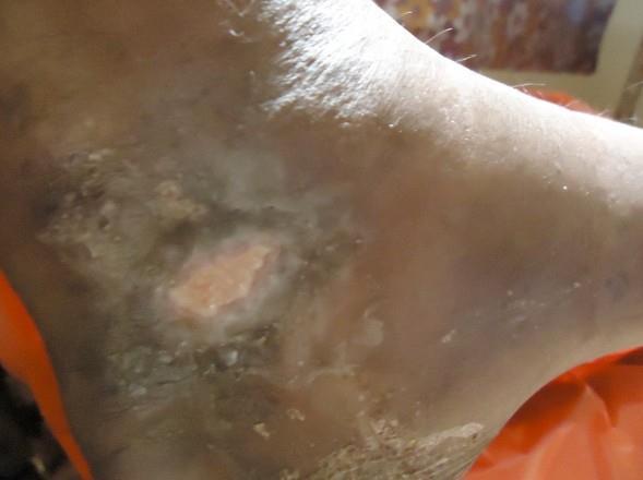 Figure 4: Case 06, Day 11 Image of leg ulcer with oedema and discharge without granulation tissue showing
