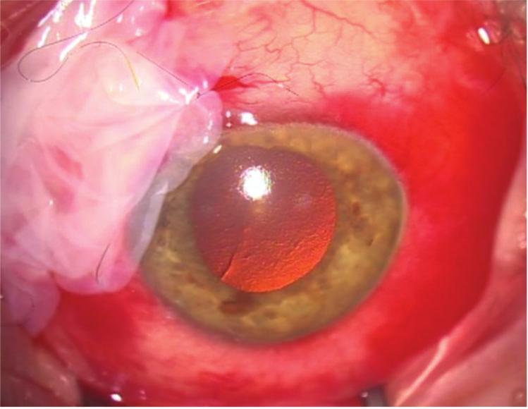 (c) After ballooning the conjunctiva with lidocaine, a larger patch of conjunctiva was excised in the inferotemporal quadrant to serve as a graft.