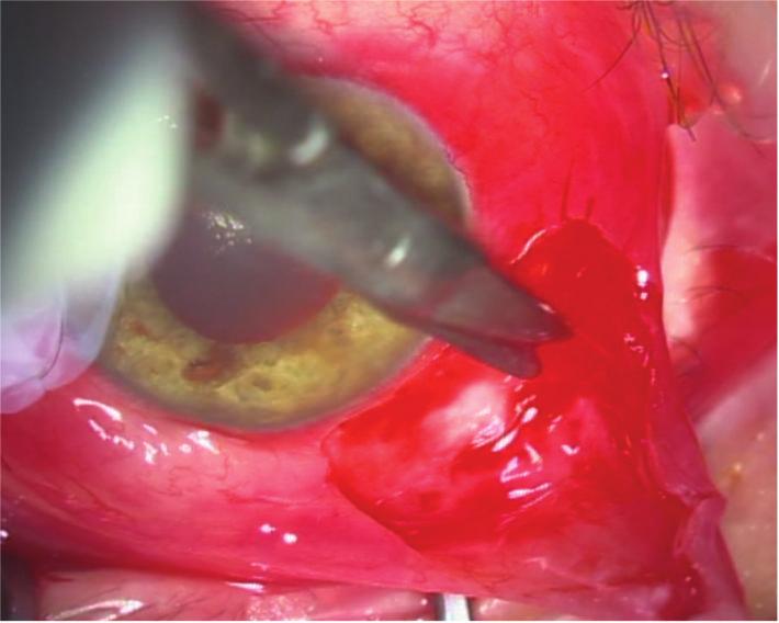 A deep suture that could not be easily removed is still visible under the conjunctiva. In this case report, we decided to take a new approach.
