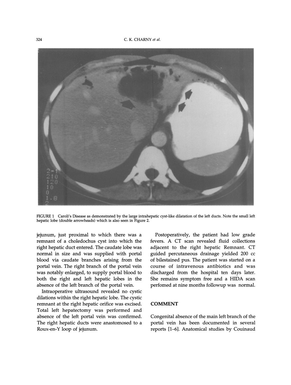 324 C.K. CHARNY et al. FIGURE 1 Caroli s Disease as demonstrated by the large intrahepatic cyst-like dilatation of the left ducts.