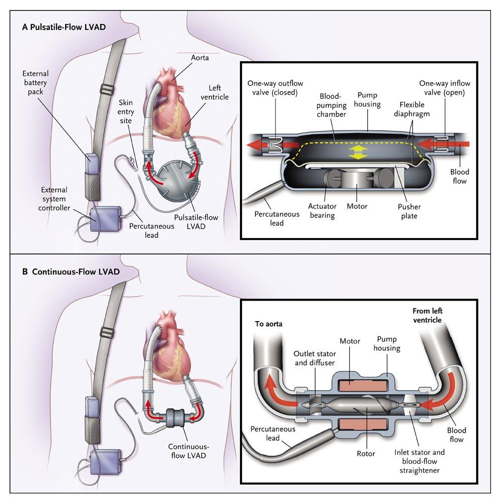 Pulsatile-Flow (Panel A) and Continuous-Flow (Panel B) Left Ventricular