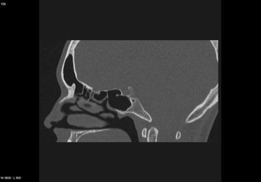 CSB: Birdseye View Optic canal Carotid sulcus F. rotundum F. ovale CSB: Birdseye View Frontal Bone Sphenoid Bone F.