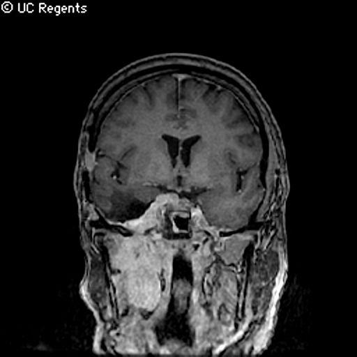 Keys to diagnosis: Sagittal images Separate lesion from pituitary