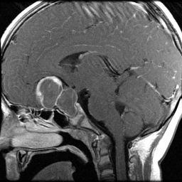 Craniopharyngioma CT Helps