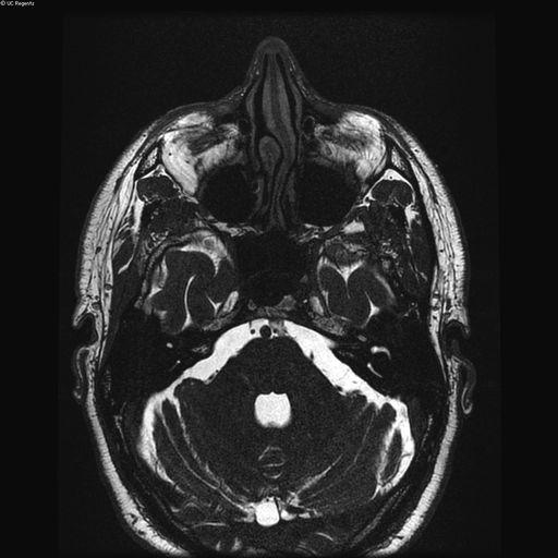 Pituitary adenoma D. Benign osseous lesion E.