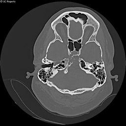 tumors Better prognosis than chordoma High signal = cartilage