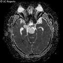 Arrested Pneumatization Chordoma Thumb Higher ADC in