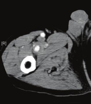 Case Reports in Vascular Medicine 3 Figure 2: Preoperative computed tomography exhibited a 22 mm right profunda femoris artery aneurysm with an intraluminal thrombus.