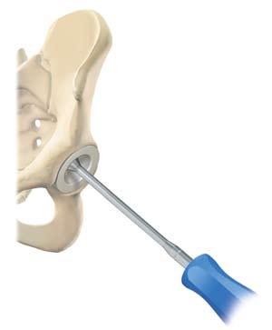 The first method utilises the resected anatomic femoral head with the head gauges.