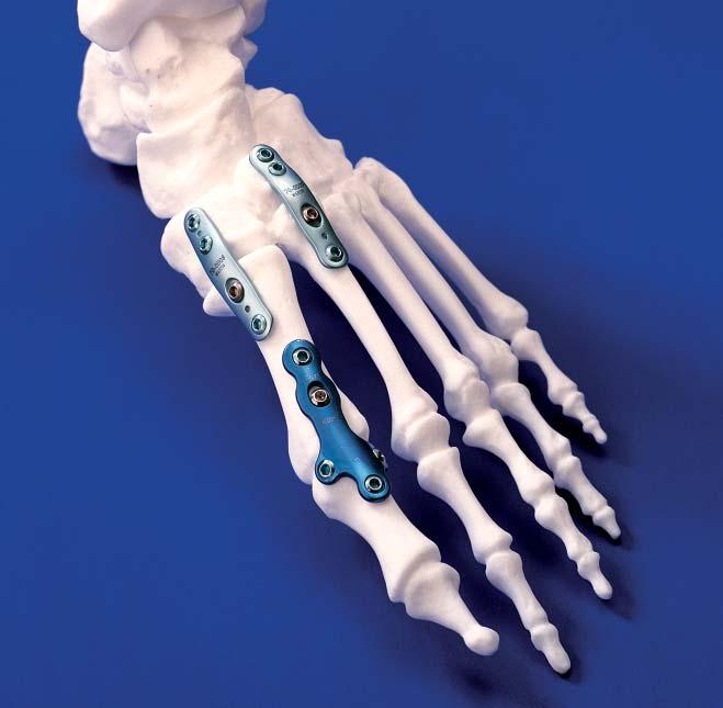 LoCKING FOREFOOT/ MIDFOOT PLATES Since 1988 Acumed has been designing solutions to the demanding situations facing orthopedic surgeons, hospitals and their patients.