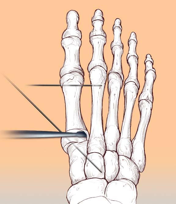 Angle is >15 1cm 6 Hallux Valgus Correction The proximal osteotomy of the fi rst metatarsal is used in conjunction with a distal soft tissue correction of the hallux valgus deformity.