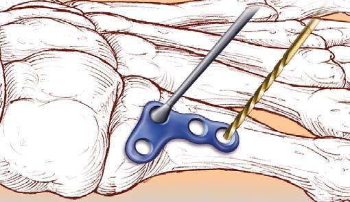 Step 1: Initial Screw Placement Place selected locking drill guide (MS-LDG27 or MS- LDG35) into the proximal medial hole and drill through both cortices.
