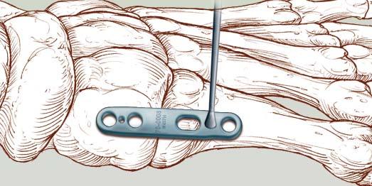 Carry dissection down to expose the anterior tibilalis tendon, which is protected.