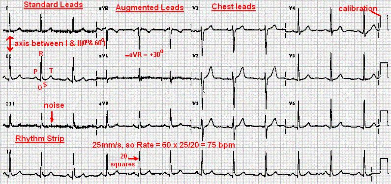 Snímka 23 4 300/ 4 = 75 bpm Example ECG the description step by step Please find attached ECG protocol In this case: Sinus rhythm (P wave is in front of each QRS complex), best seen in lead II