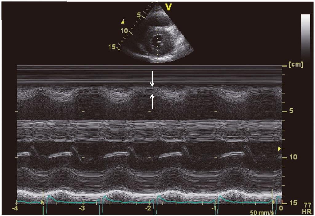 aphy of Cardiac Amyloidoses 725 Speckle tracking echocardiography Modesto et al 61 2006 / Eur J Sun et al 62 2009 / 17 (AL) 2D strain echocardiography values correlated closely with tissue