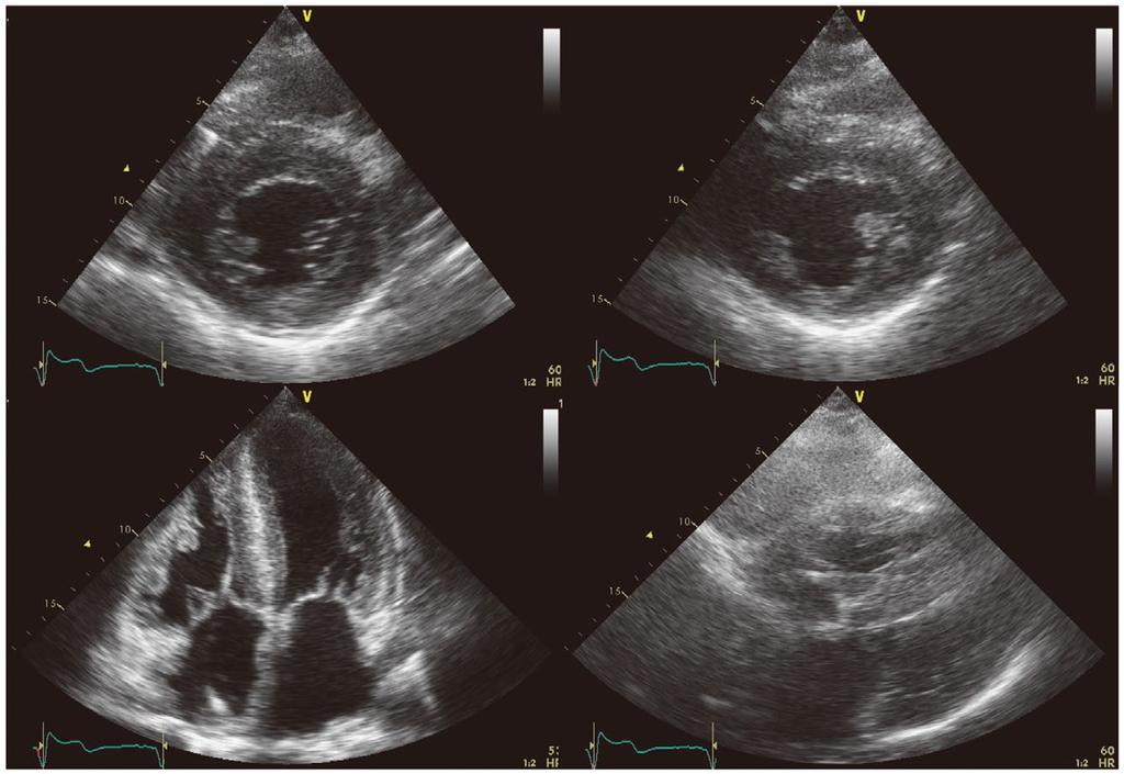 726 KOYAMA J et al. Figure 2. Two-dimensional echocardiography. Thickening of the right, left ventricular, and atrial walls can be seen. using M-mode echocardiography in 3 cases.