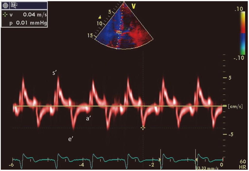 aphy of Cardiac Amyloidoses 729 Figure 4. Pulsed tissue Doppler imaging. The systolic and diastolic pulsed tissue Doppler velocities are decreased in advanced cardiac amyloidosis.