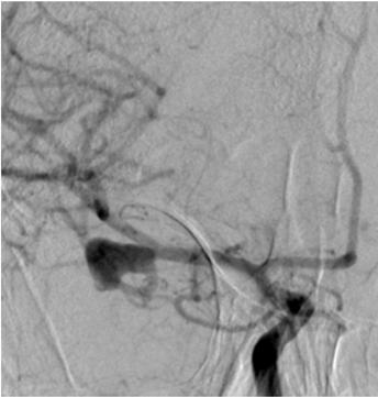 68 Ion et al - Contralateral clipping of bilateral middle cerebral artery aneurysms Steps: 1.