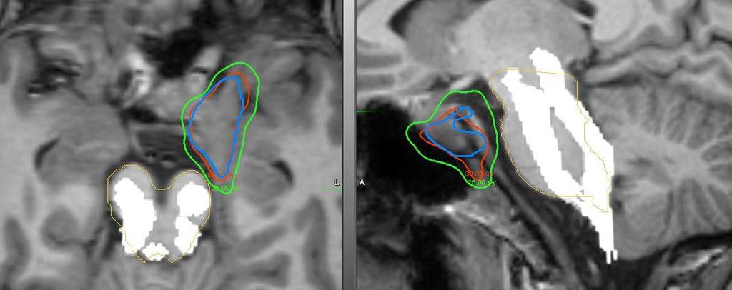 Radiotherapy process in Kuopio Pre-treatment imaging Fusions and contouring Treatment planning CT: 1 mm slices