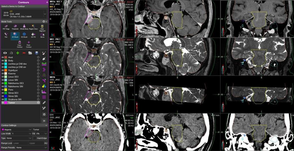 5) CT+Multiple MRIs can be shown on the same layout Same structure can be contoured on all
