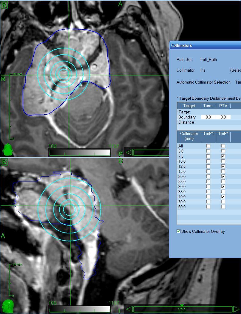 Radiotherapy process in Kuopio Pre-treatment imaging Fusions and contouring Treatment planning Template based Sequential