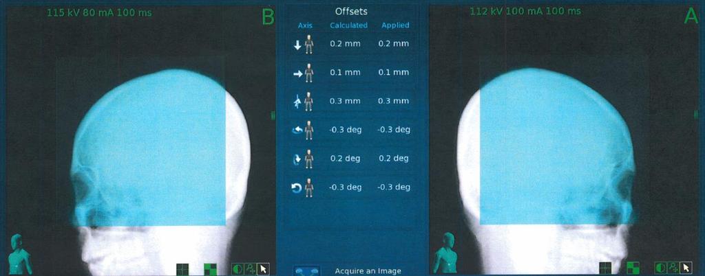 Target tracking during the treatment 6D Skull Corrections are calculated and applied