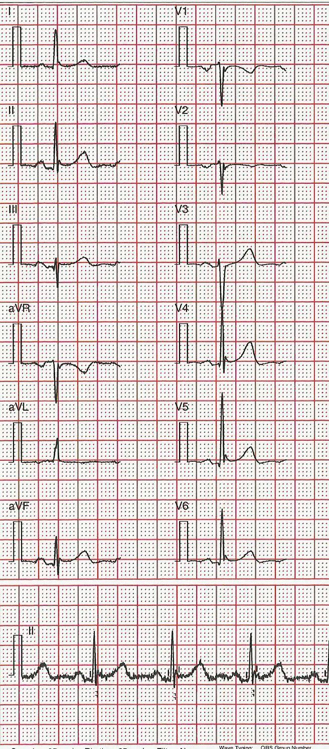 12 Figure 7 An ECG which meets the new definition of early repolarisation with end QRS notching, Jp 0.1mV and a QRSd < 120ms in V5, V6. Note that Jt < 0.